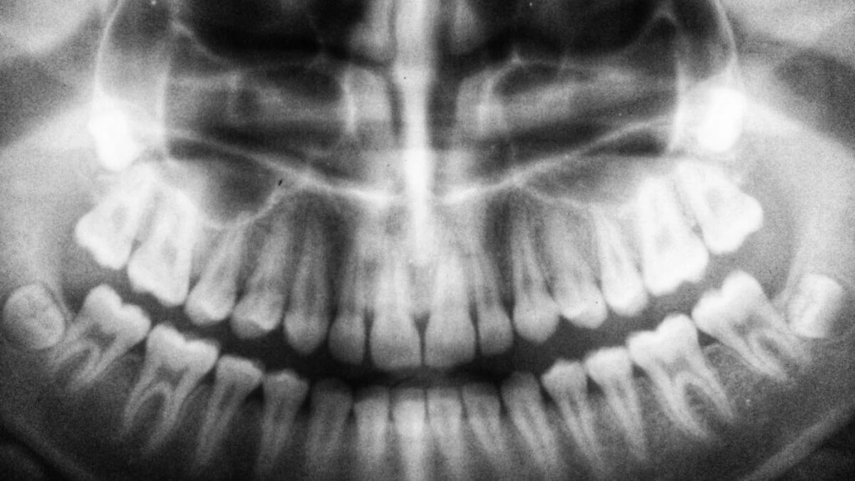 teeth X-ray