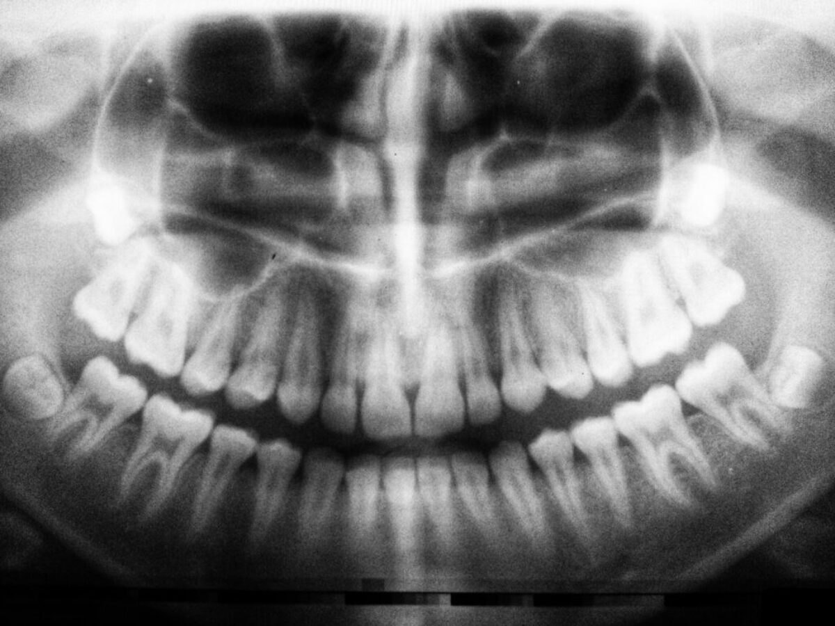 teeth X-ray