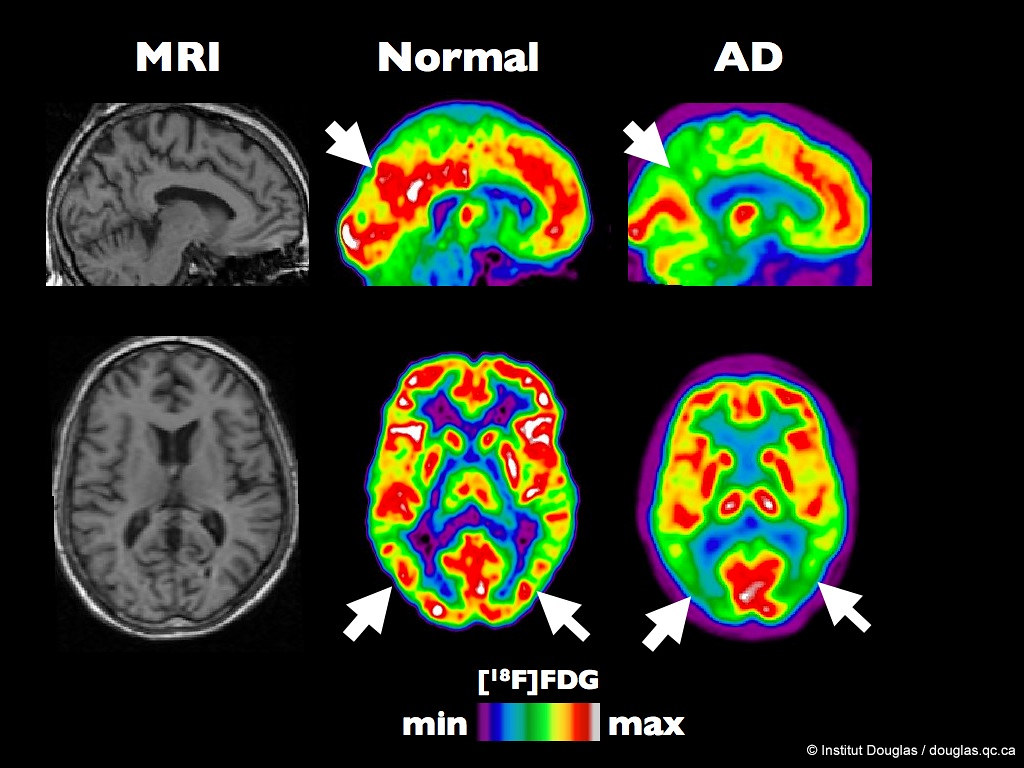Scan mozku, porovnává zdravý mozek s mozkem v počátečním stádiu Alzheimerovy choroby