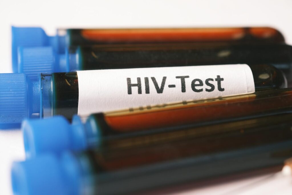 HIV, AIDS - Techsvět Blood Samples for HIV Test