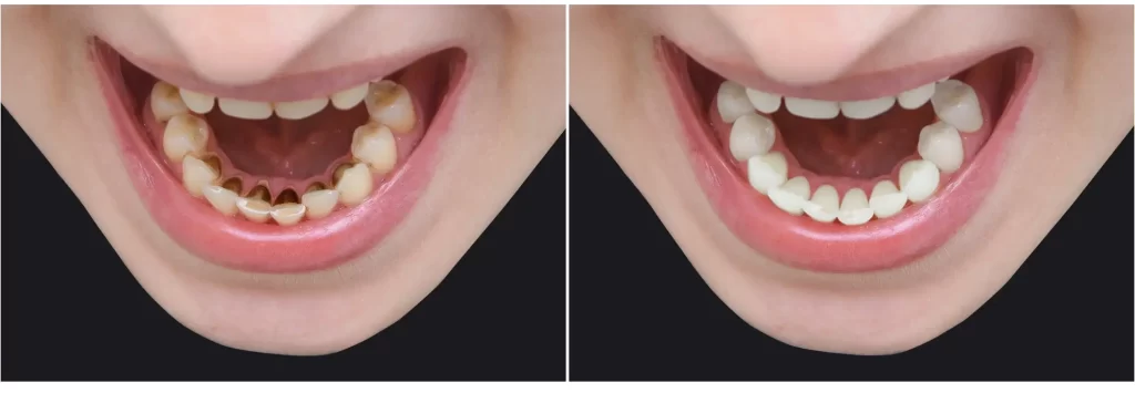 Zuby bez zubního kamene před a po