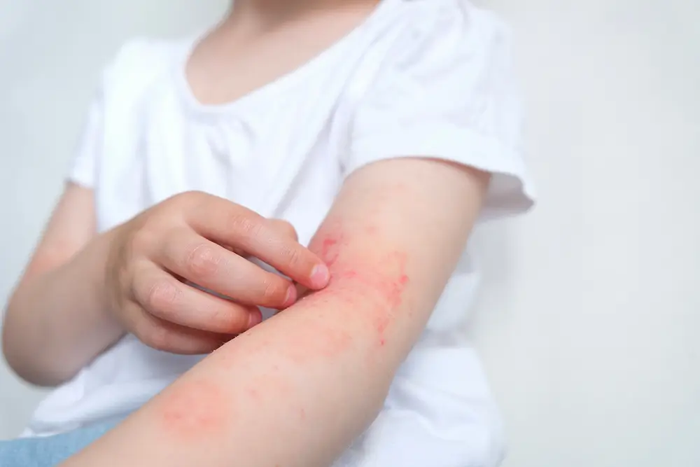 Některé alergické projevy je možné zaměnit za podlitiny. - Techsvět holčička si škrábe vyrážku na ruce