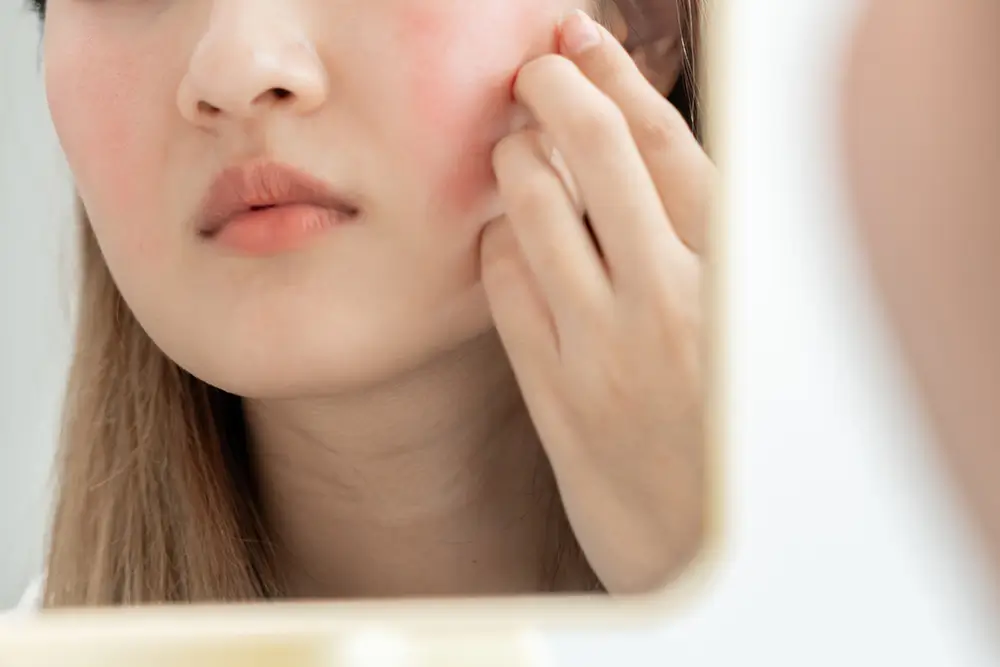 Růžovka je zánětlivé onemocnění kůže a postihuje ženy i muže. Zdroj: Shutterstock - Techsvět detail začervenalého obličeje